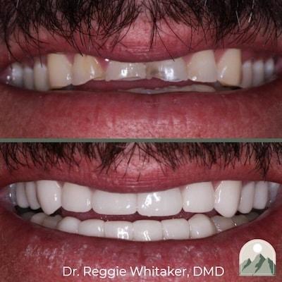 Roy Dental Care smile makeover result — Roy, UT