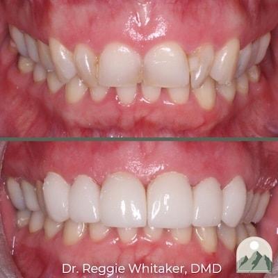 Roy Dental Care veneers result — Roy, UT