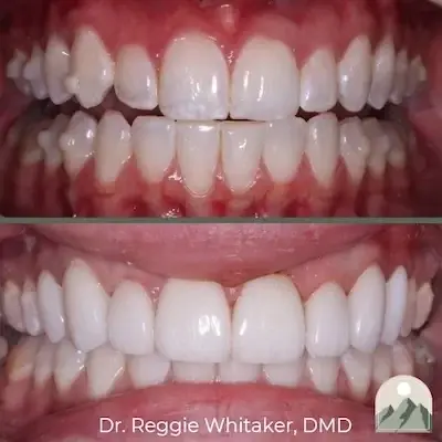Roy Dental Care veneers result — Roy, UT
