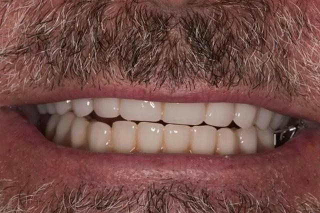 Dental Implants after at Roy Dental Care in Roy, UT