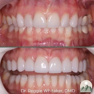 Dental Veneers result at Roy Dental Care in Roy, UT
