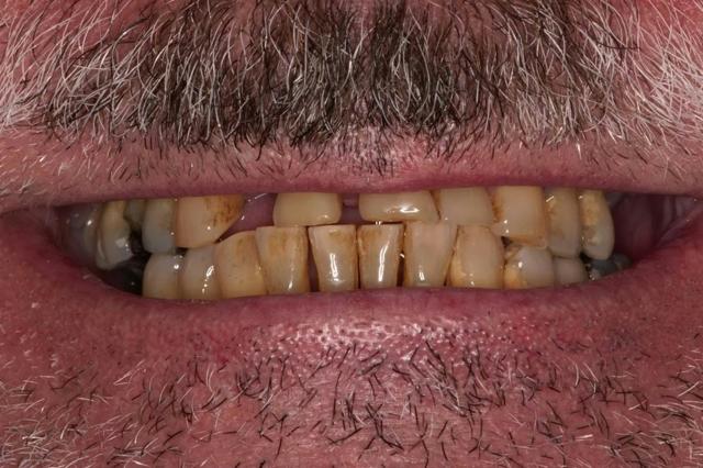 Dental Implants before at Roy Dental Care in Roy, UT