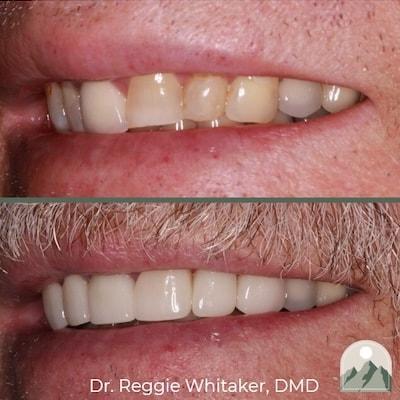 Roy Dental Care veneers result — Roy, UT