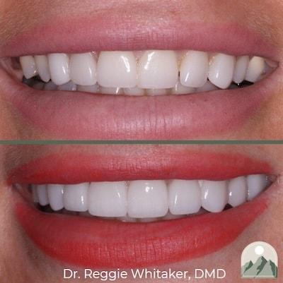 Roy Dental Care veneers result — Roy, UT