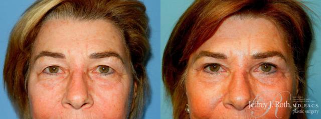 Blepharoplasty result at Jeffrey J. Roth, MD Plastic Surgery in Las Vegas, NV
