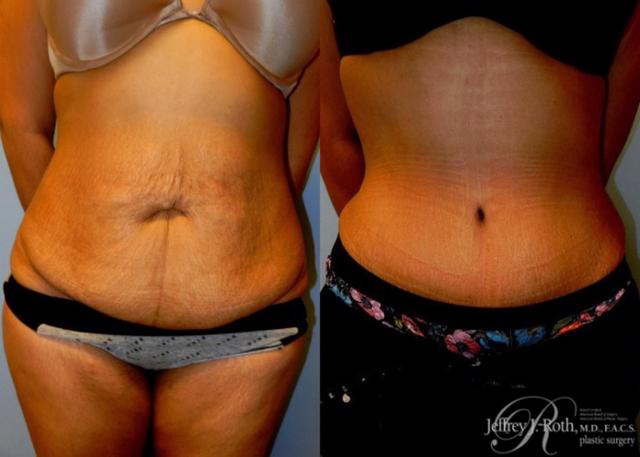 Mini Tummy Tuck result at Jeffrey J. Roth, MD Plastic Surgery in Las Vegas, NV
