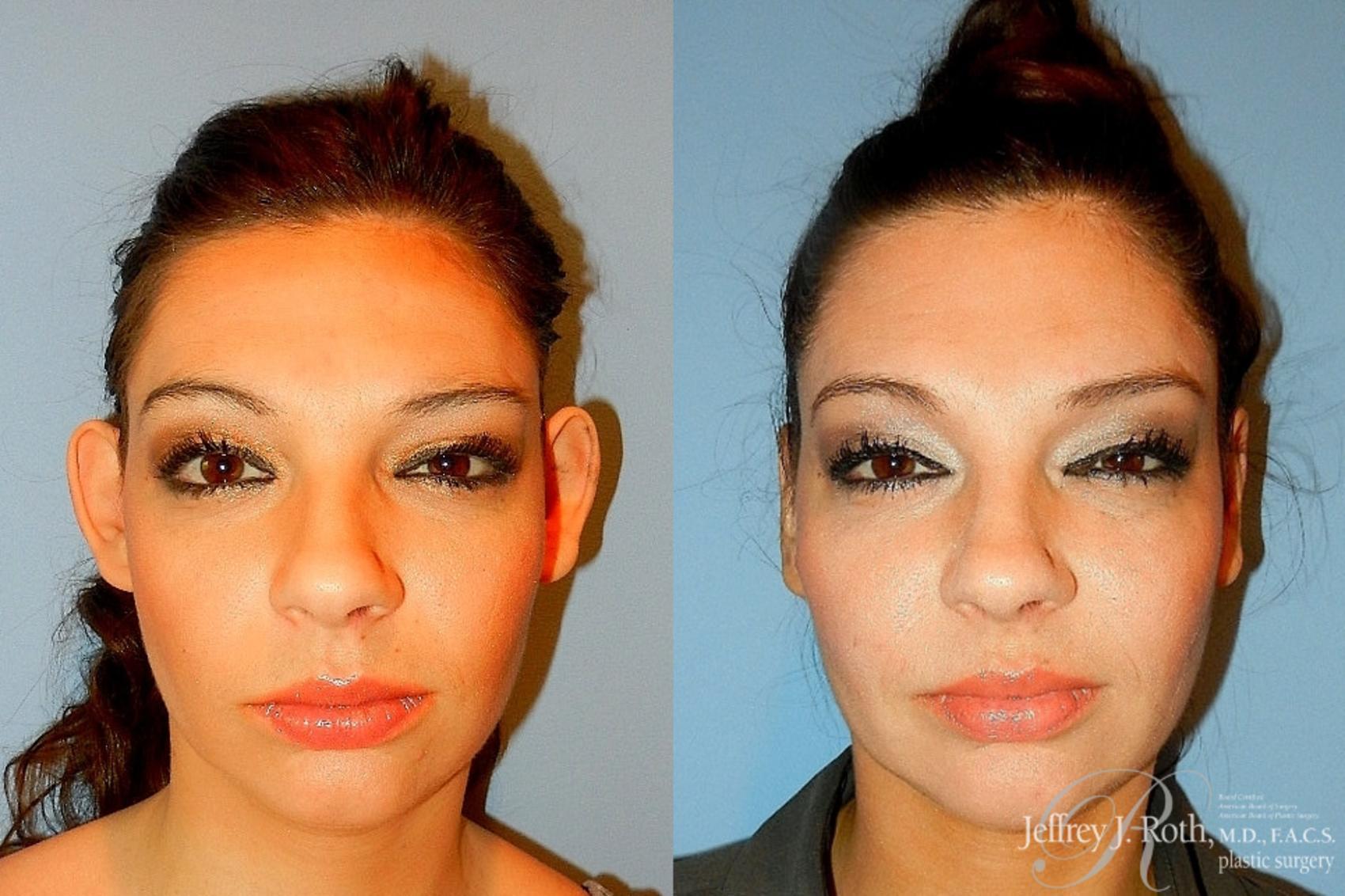 Jeffrey J. Roth, MD Plastic Surgery otoplasty result — Las Vegas, NV
