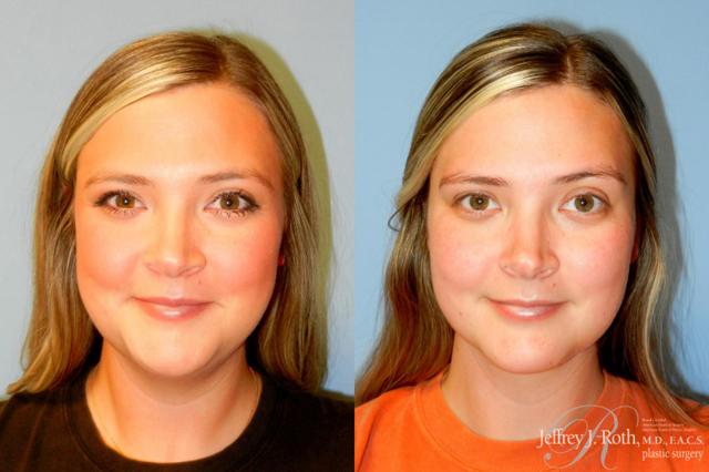 Liposuction result at Jeffrey J. Roth, MD Plastic Surgery in Las Vegas, NV