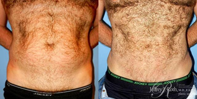 Liposuction result at Jeffrey J. Roth, MD Plastic Surgery in Las Vegas, NV