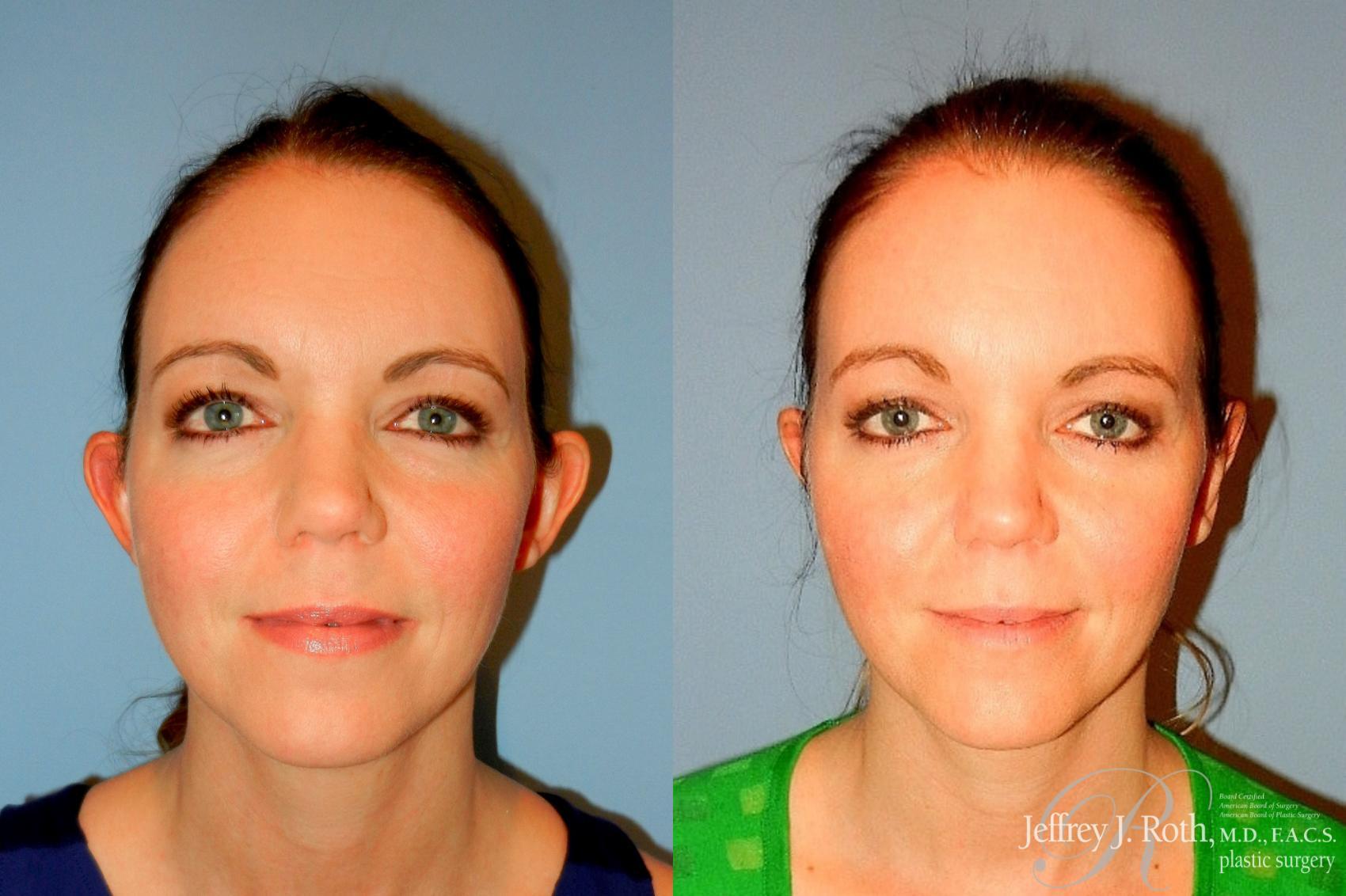 Jeffrey J. Roth, MD Plastic Surgery otoplasty result — Las Vegas, NV