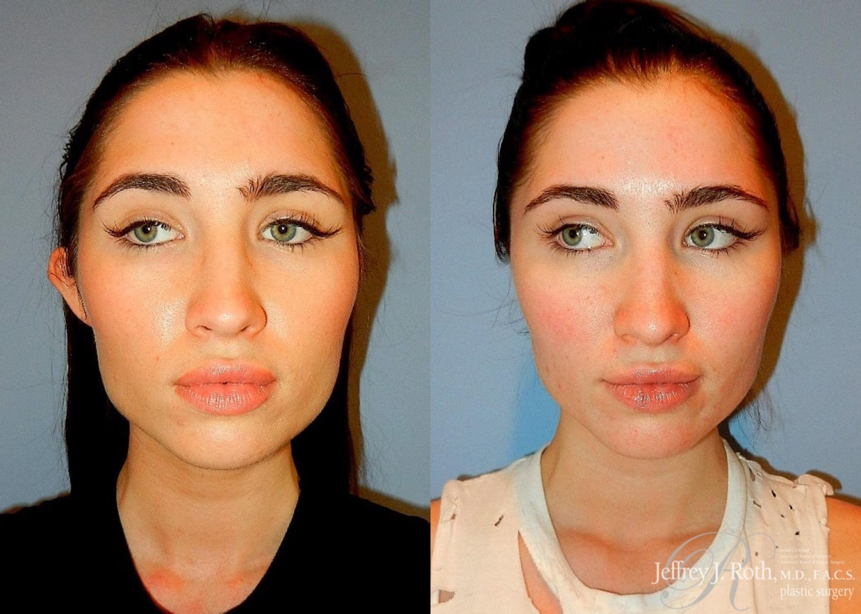 Jeffrey J. Roth, MD Plastic Surgery otoplasty result — Las Vegas, NV