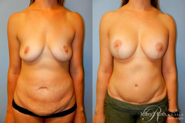 Tummy Tuck result at Jeffrey J. Roth, MD Plastic Surgery in Las Vegas, NV