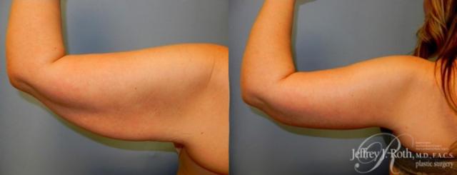 CoolSculpting result at Jeffrey J. Roth, MD Plastic Surgery in Las Vegas, NV