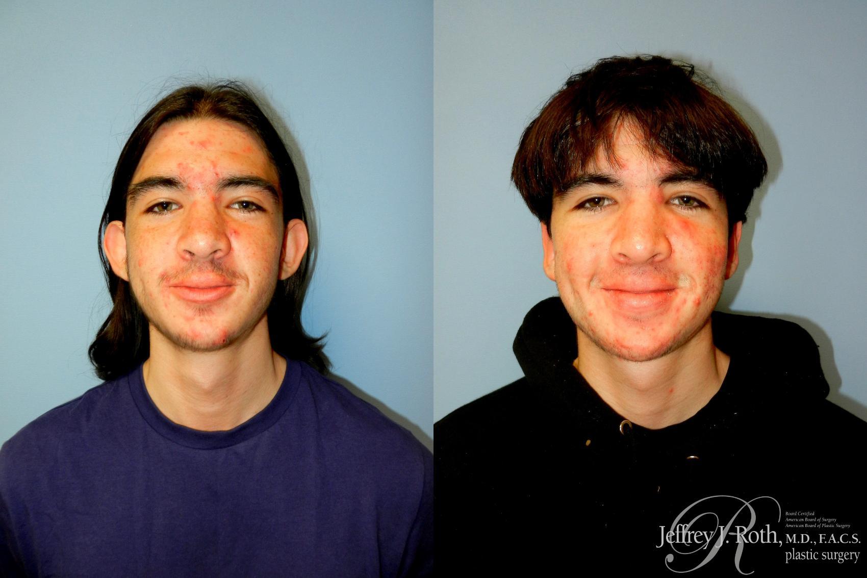 Jeffrey J. Roth, MD Plastic Surgery ear pinning result — Las Vegas, NV