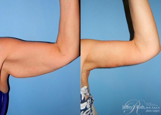 CoolSculpting result at Jeffrey J. Roth, MD Plastic Surgery in Las Vegas, NV