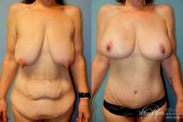 Mommy Makeover result at Jeffrey J. Roth, MD Plastic Surgery in Las Vegas, NV