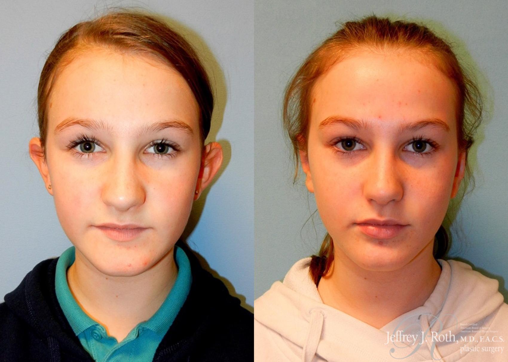 Jeffrey J. Roth, MD Plastic Surgery otoplasty result — Las Vegas, NV
