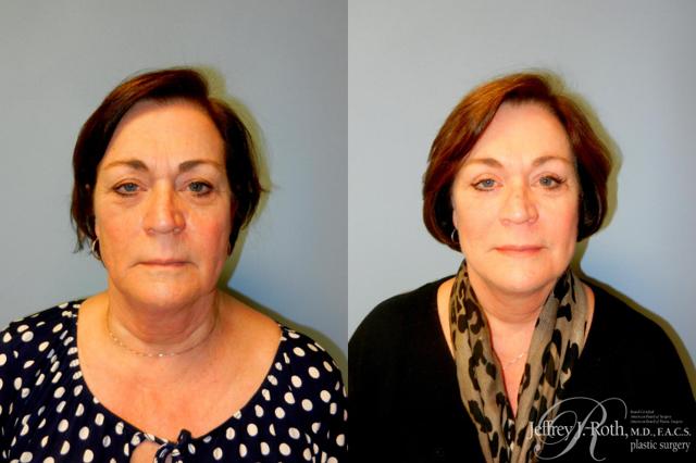 Facelift result at Jeffrey J. Roth, MD Plastic Surgery in Las Vegas, NV