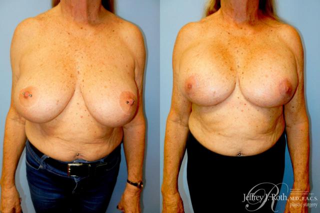 Breast Lift result at Jeffrey J. Roth, MD Plastic Surgery in Las Vegas, NV