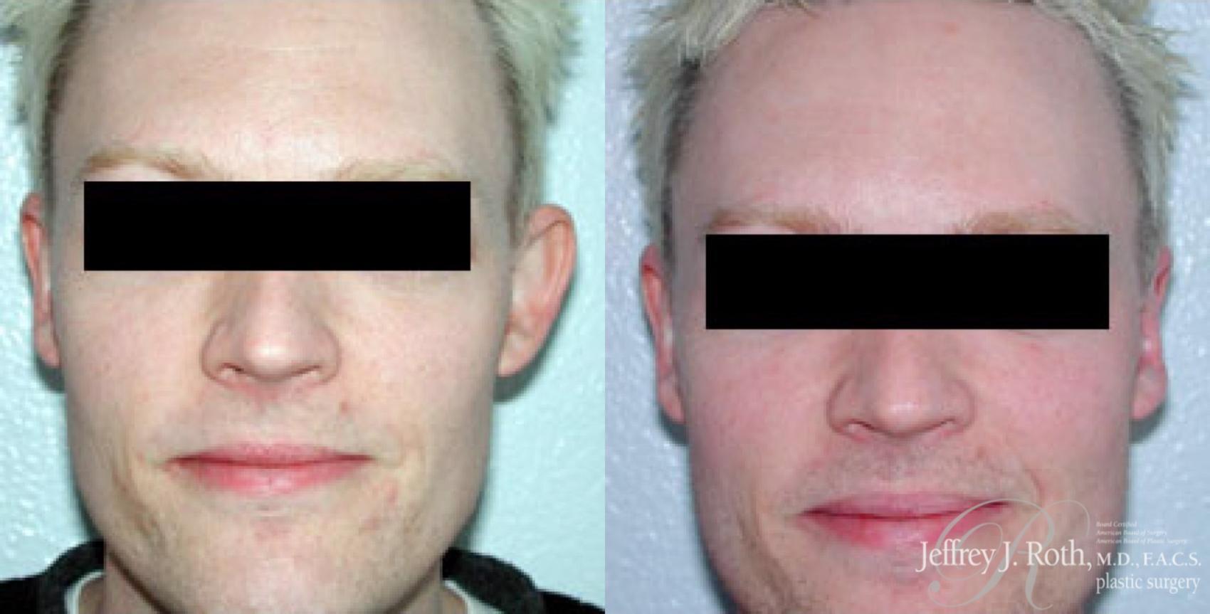 Jeffrey J. Roth, MD Plastic Surgery otoplasty result — Las Vegas, NV