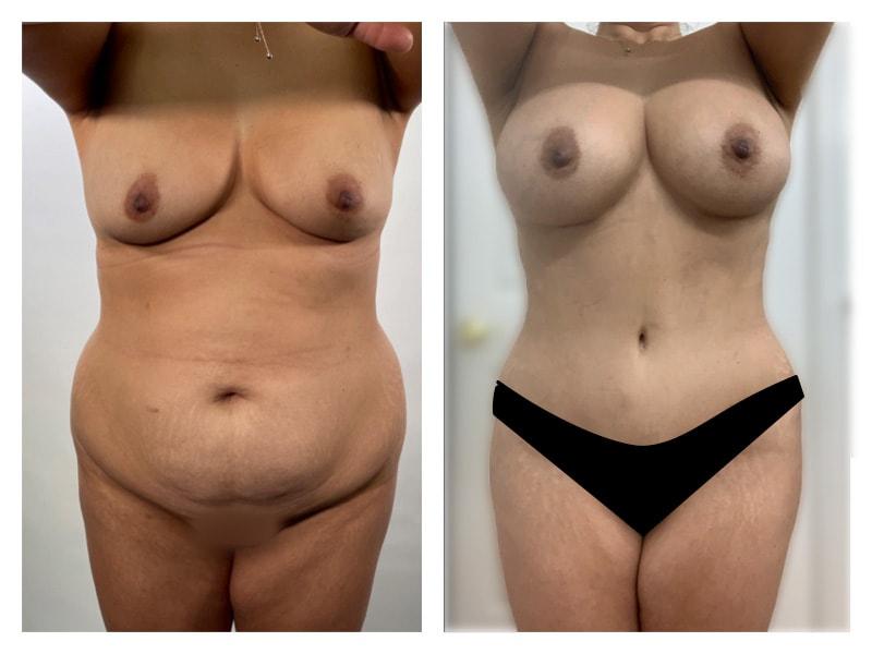Top Aesthetics mommy makeover result — Oakland Park, FL