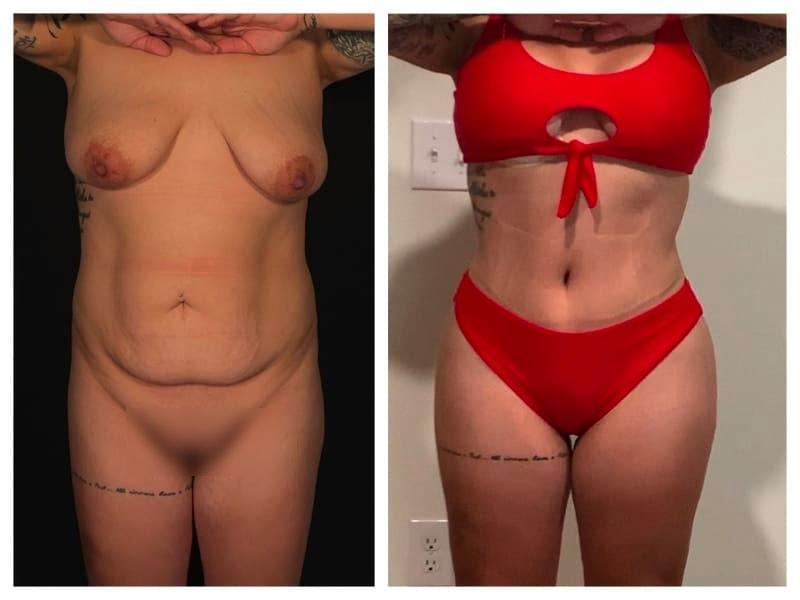 Top Aesthetics mommy makeover result — Oakland Park, FL