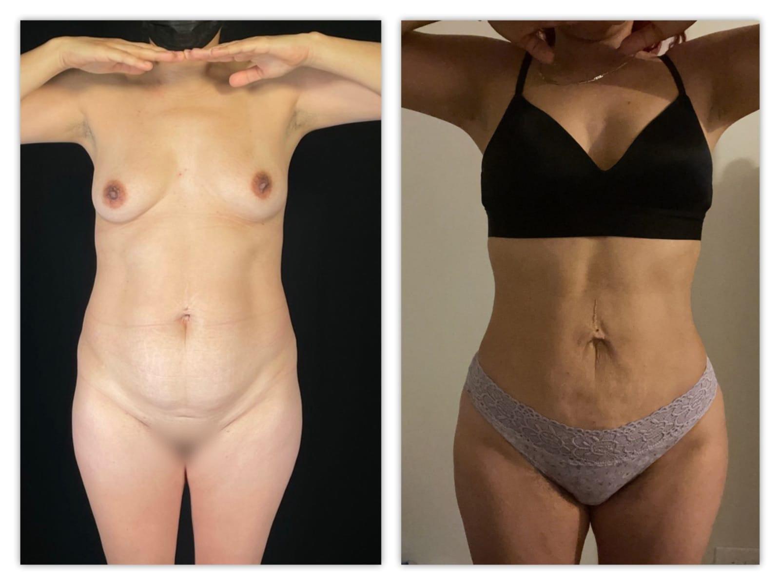 Top Aesthetics liposuction result — Oakland Park, FL