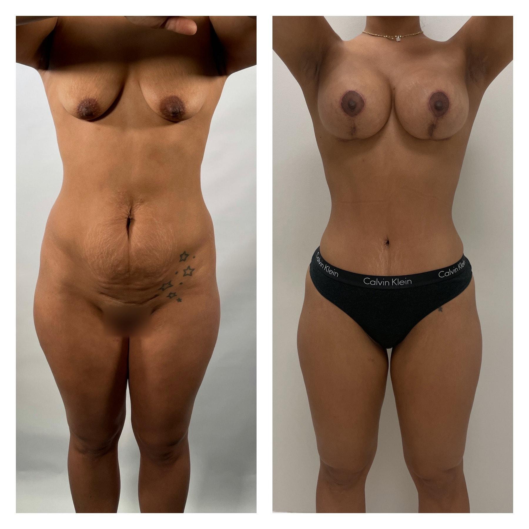 Top Aesthetics mommy makeover result — Oakland Park, FL