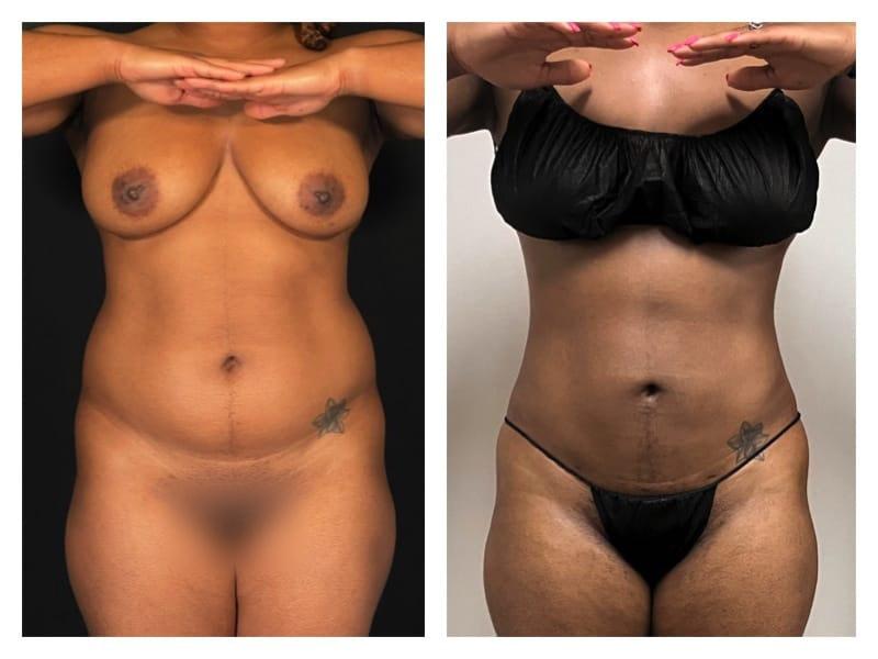 Top Aesthetics liposuction result — Oakland Park, FL