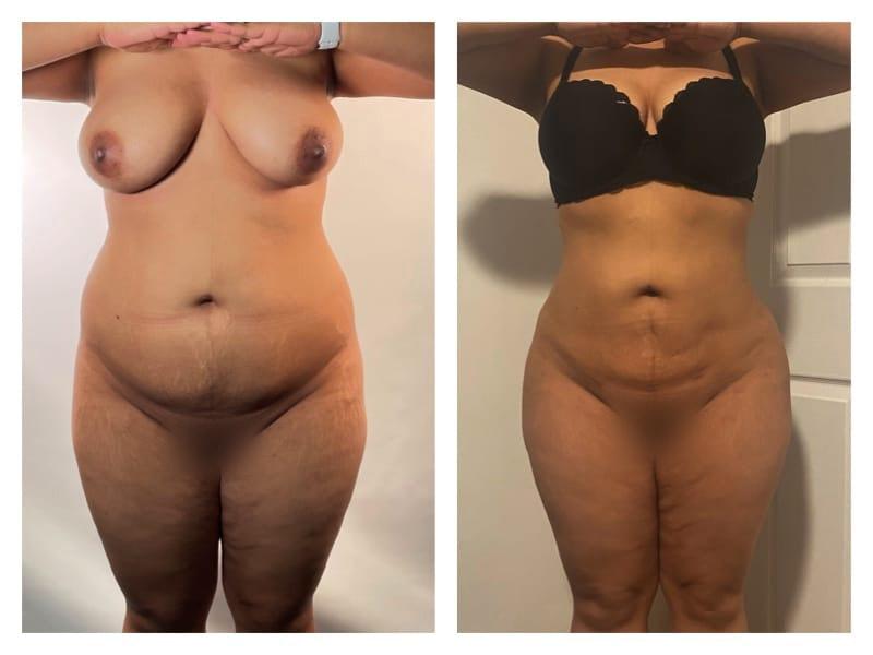 Top Aesthetics liposuction result — Oakland Park, FL