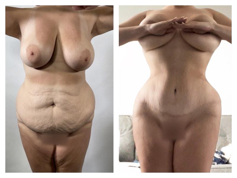 Top Aesthetics mommy makeover result — Oakland Park, FL