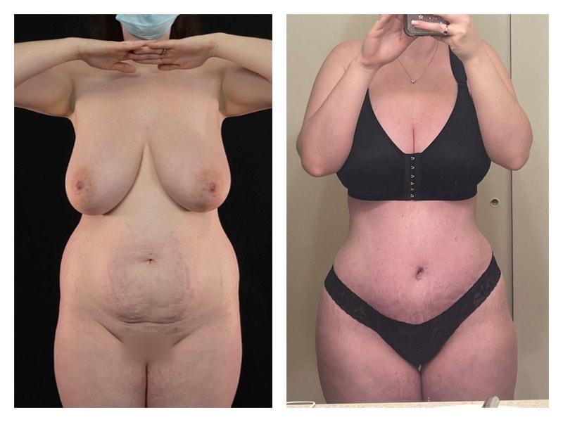 Top Aesthetics mommy makeover result — Oakland Park, FL