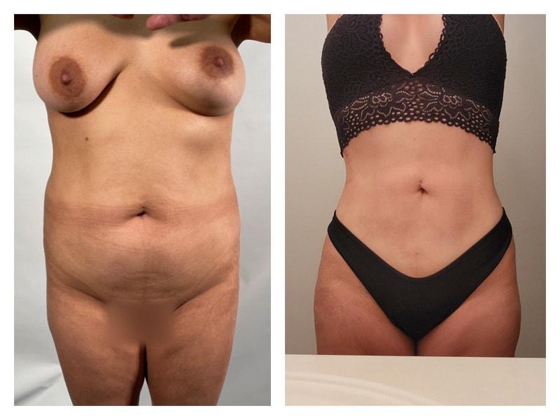 Top Aesthetics liposuction result — Oakland Park, FL