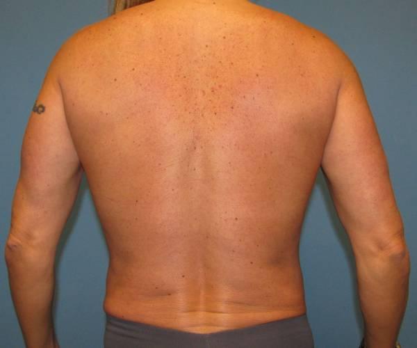 Crispin Plastic Surgery liposuction after — Atlanta, GA