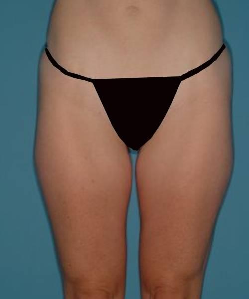 Liposuction after at Crispin Plastic Surgery in Atlanta, GA