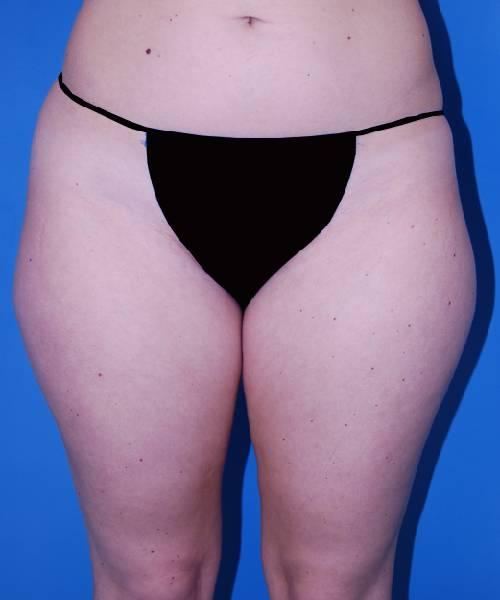 Liposuction before at Crispin Plastic Surgery in Atlanta, GA