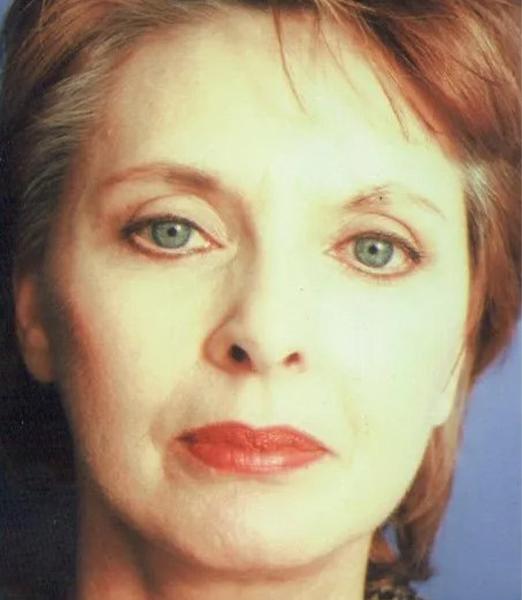 Crispin Plastic Surgery blepharoplasty after — Atlanta, GA