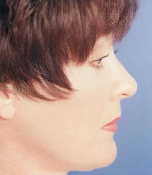 Crispin Plastic Surgery blepharoplasty after — Atlanta, GA