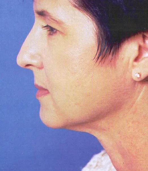 Facelift after at Crispin Plastic Surgery in Atlanta, GA