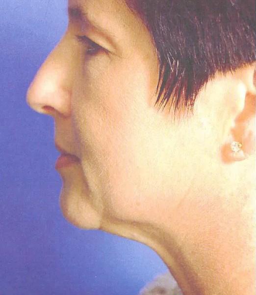 Facelift before at Crispin Plastic Surgery in Atlanta, GA