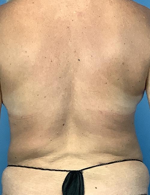 Crispin Plastic Surgery liposuction after — Atlanta, GA