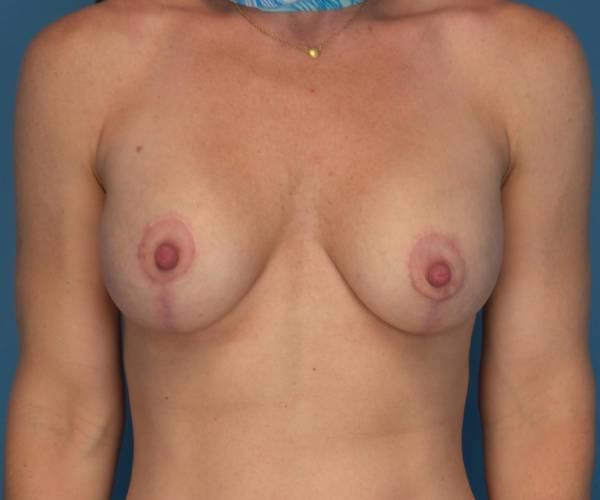 Crispin Plastic Surgery breast lift after — Atlanta, GA