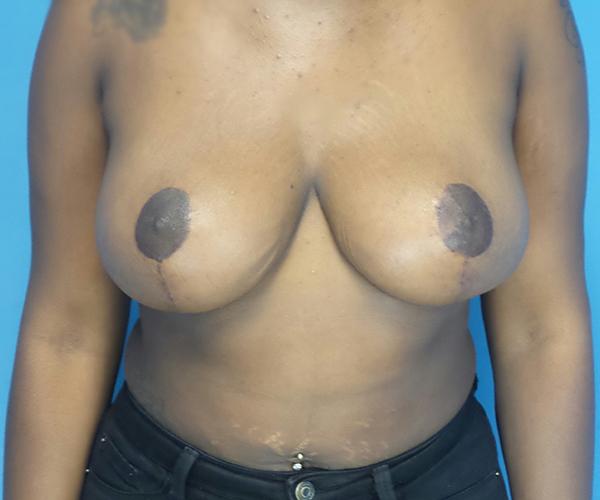 Crispin Plastic Surgery breast reduction after — Atlanta, GA