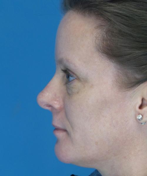 Crispin Plastic Surgery rhinoplasty after — Atlanta, GA