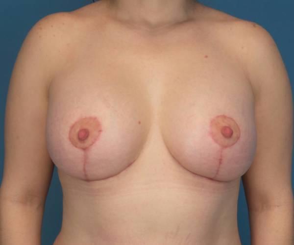 Crispin Plastic Surgery breast lift after — Atlanta, GA