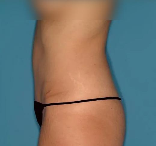 Crispin Plastic Surgery tummy tuck after — Atlanta, GA