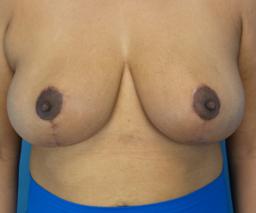 Crispin Plastic Surgery breast augmentation result
