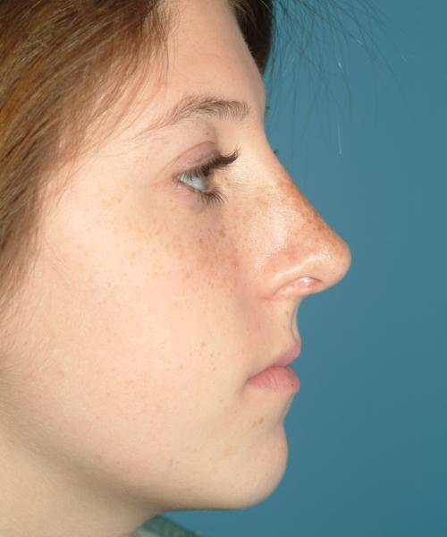 Ethnic Rhinoplasty after at Crispin Plastic Surgery in Atlanta, GA