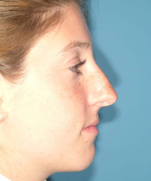 Ethnic Rhinoplasty before at Crispin Plastic Surgery in Atlanta, GA