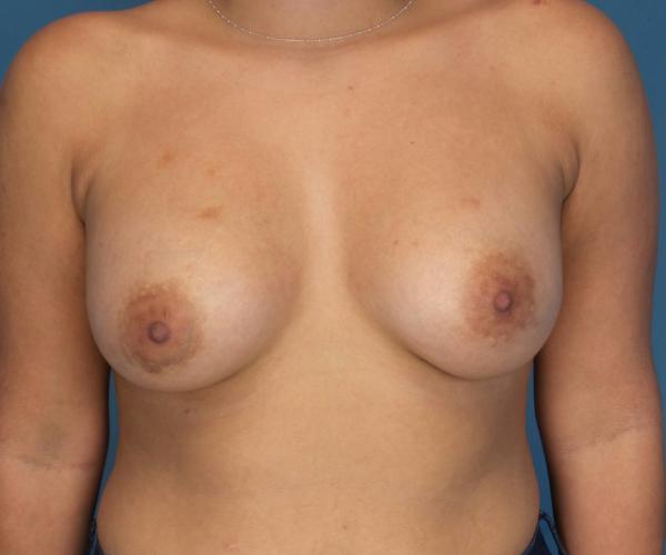 Crispin Plastic Surgery breast augmentation after — Atlanta, GA